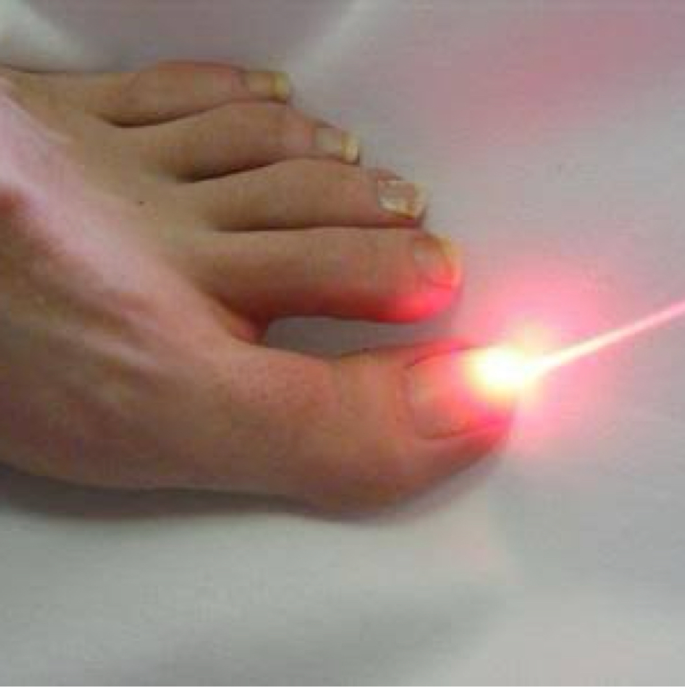 Laser Toenail Fungus Treatment at Luminous Glow Skin & Laser in Buckeye, AZ