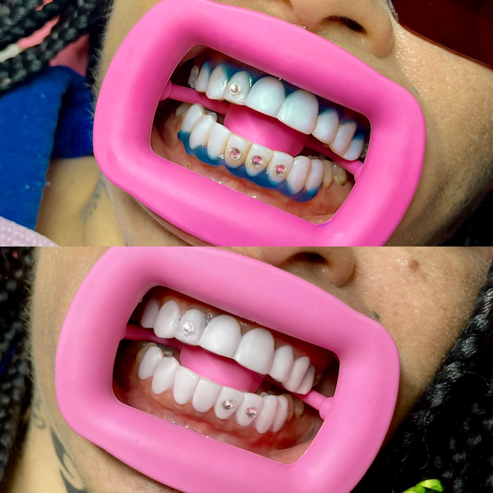 Professional Teeth Whitening