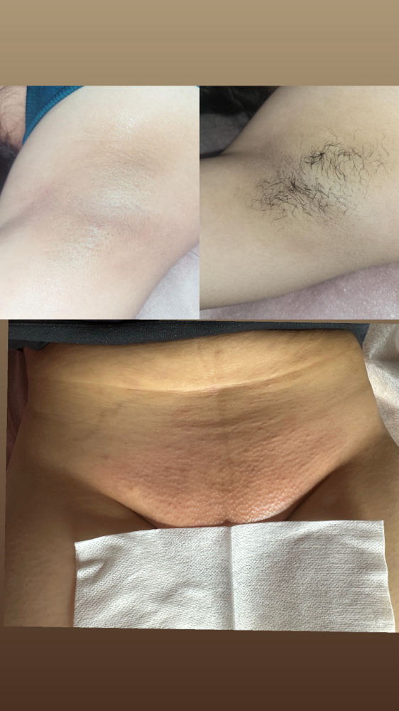 Brazilian + Underarms WednesdayOnly