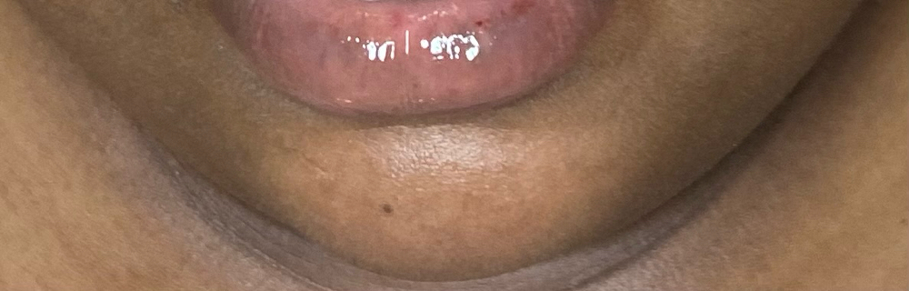 Chin Hair Removal