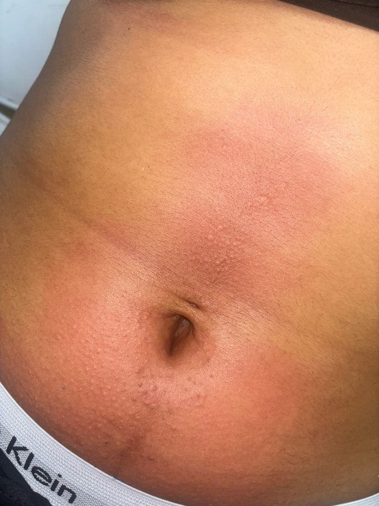 Stomach Wax at Glogetteresthetics in Warwick, RI