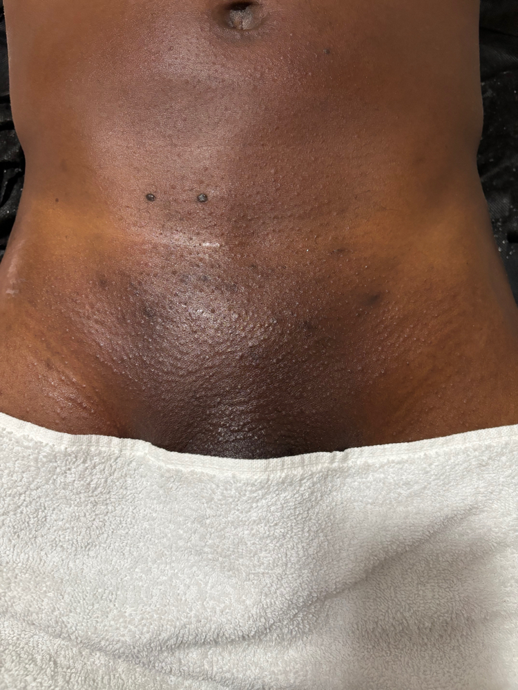 Manzilian Treatment at The Cave Experience in Yonkers, NY