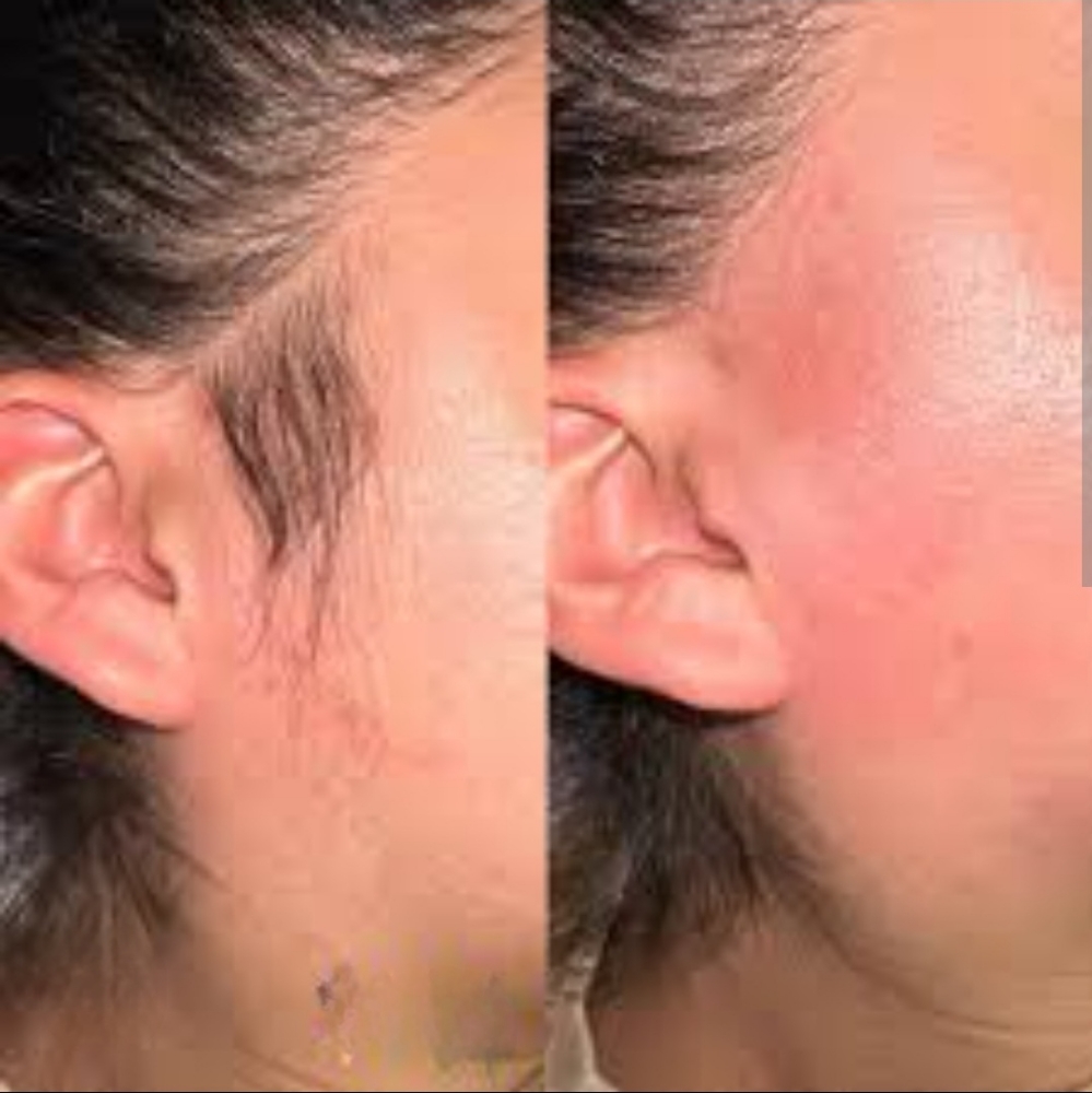 Cheek/Side Burns