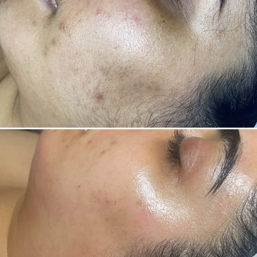 Dermaplaning + 60 Min Facial