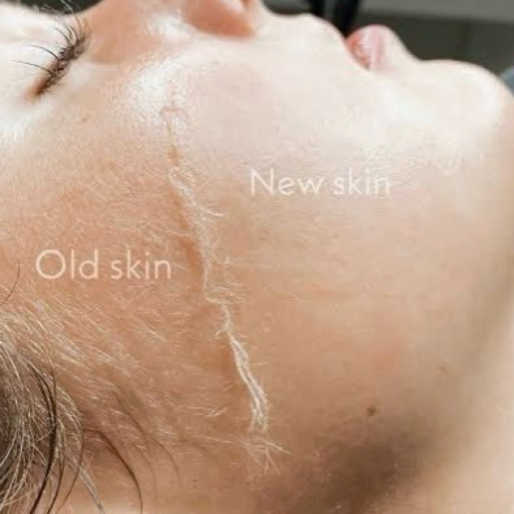 Dermaplaning Treatment at Antidote Mobile Studio