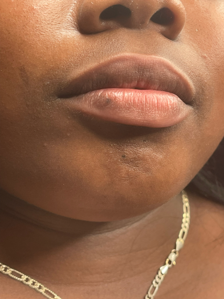 Lips NEEDLESS
