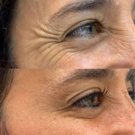 Crows Feet Botox Treatment at Glam X Sam MedBeauty in Andrews, TX