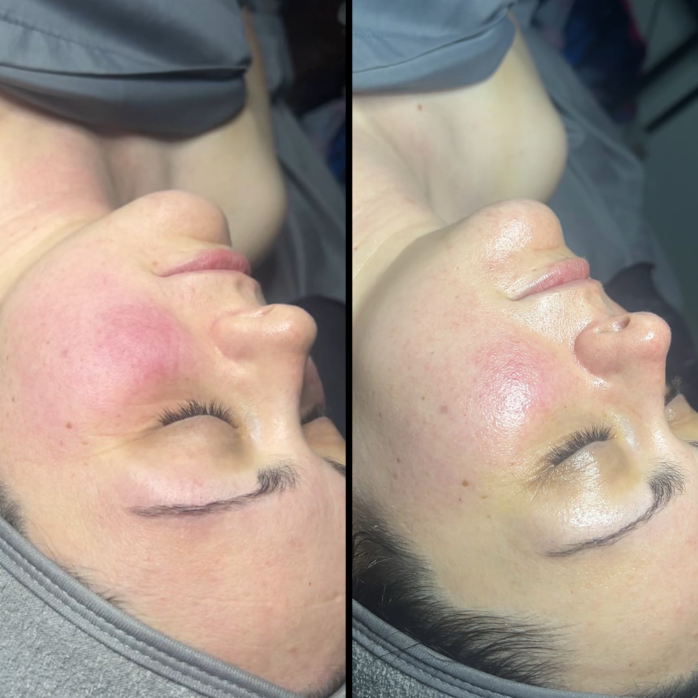 Calming/Rosacea facial