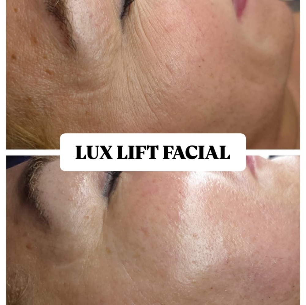 Lux Lift Facial