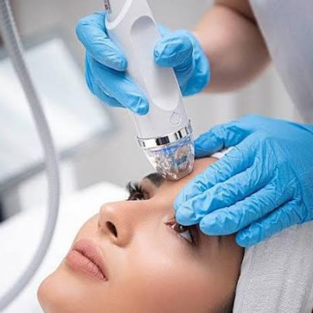 Fractional RF ( Acne scars ) at Acnessia Laser Clinic in Guaynabo, PR