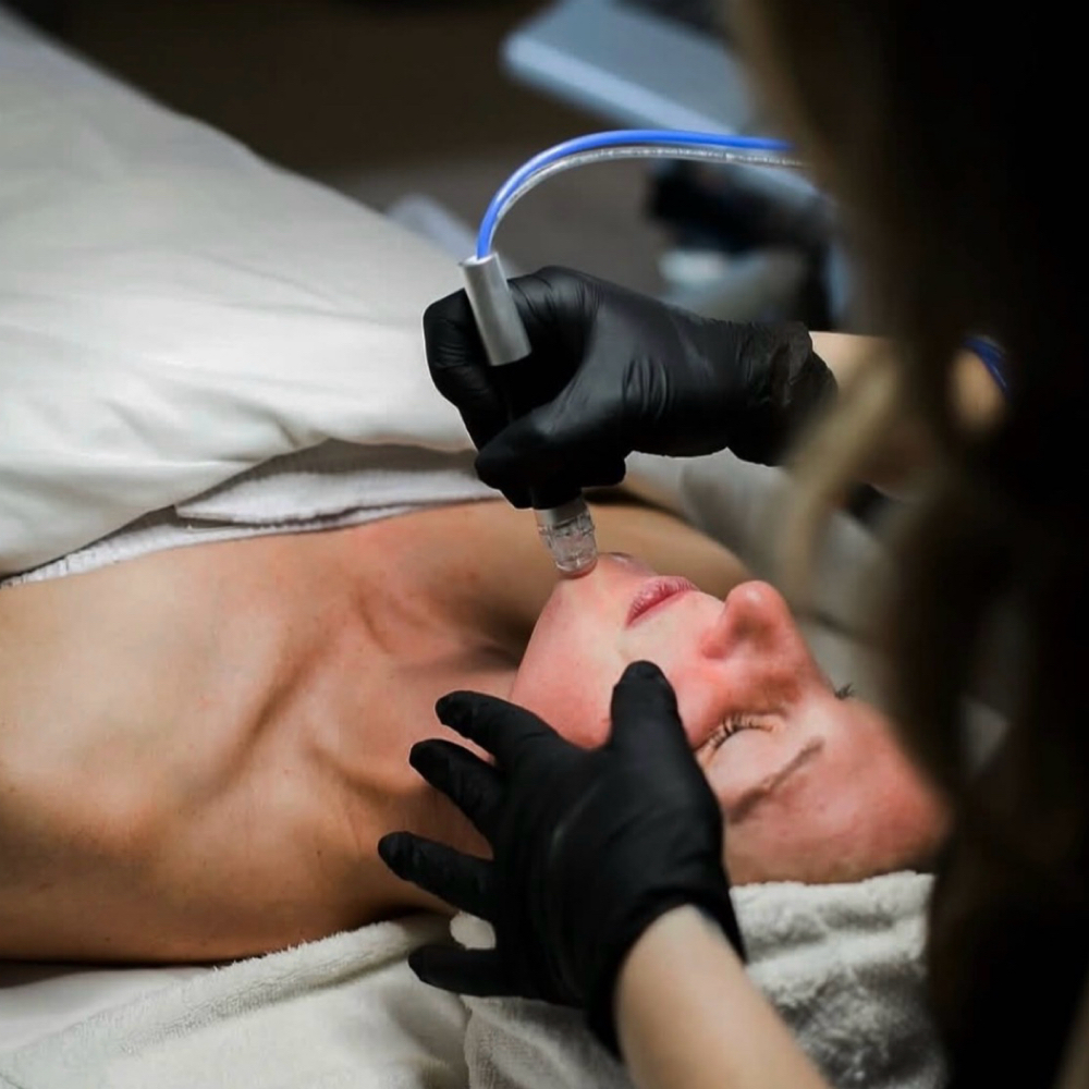 Hydrodermabrasion Facial at Skin and Brows by Carol in Denver, CO