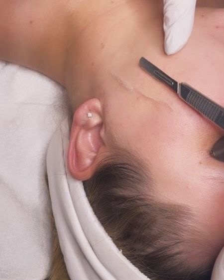 Dermaplaning Facial