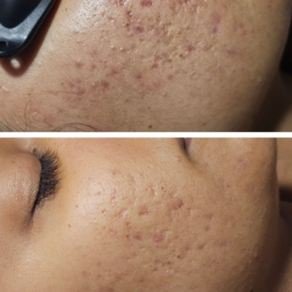 Korean Acne Clearing Peel at Sugar Suite by Auburey Aesthetics in Scottsdale, AZ