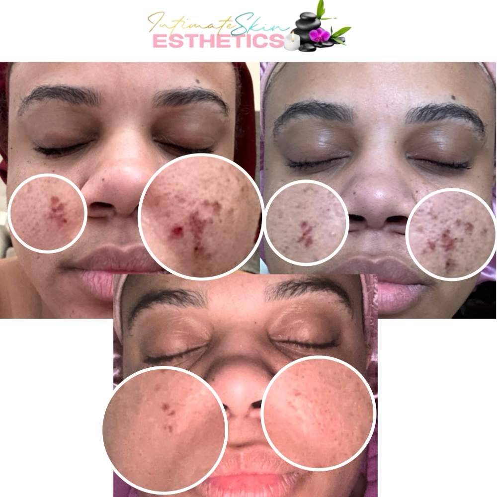 ISE Facial Packages & Programs at Rockii’s intimate skin & esthetics in Va Beach, VA