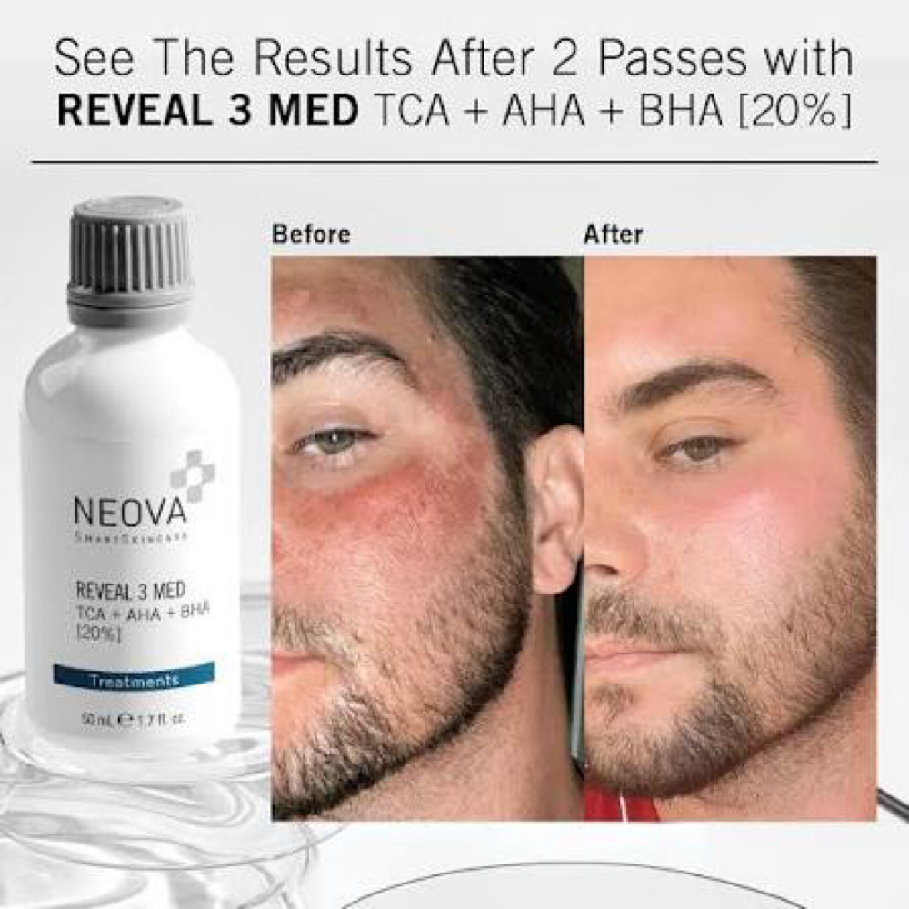 TCA Chemical Peel at Allure Aesthetics & Wellness Studio in Midwest City, OK