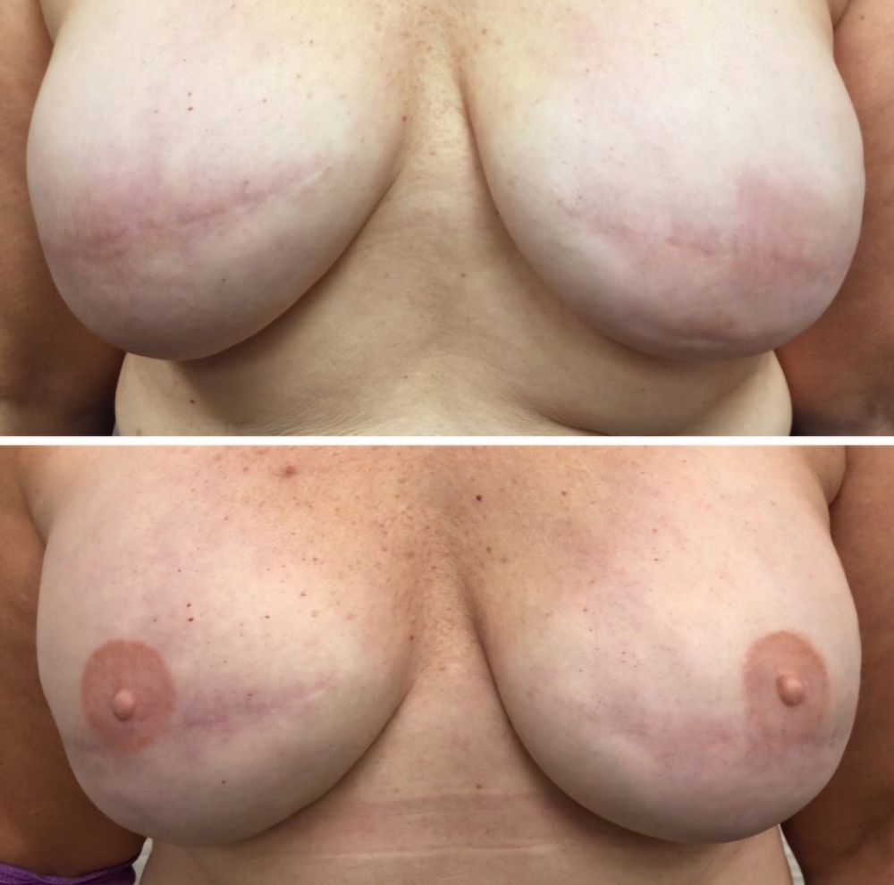 Nipple/Areola Correction