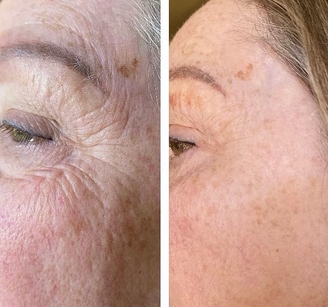 Cold Jet Facial