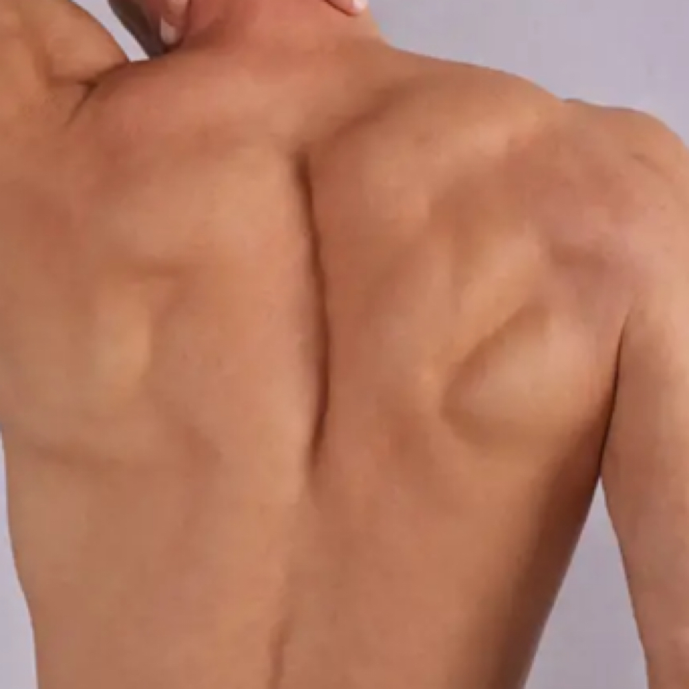 Back Laser Hair Removal