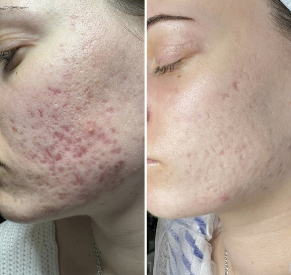 Acne Solution