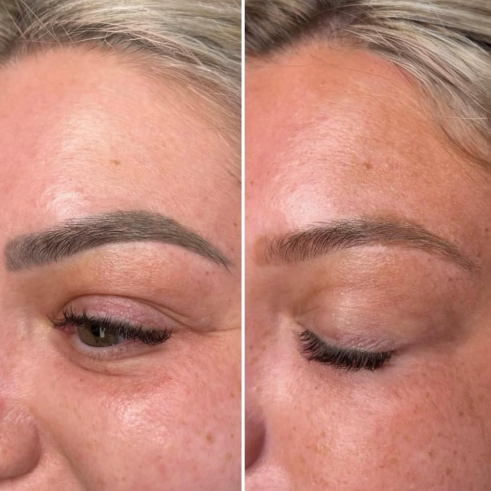 PMU Tattoo Removal at V Glow Miami in Miami Beach, FL