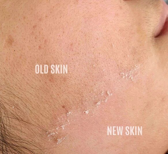 Chemical Peel Facial