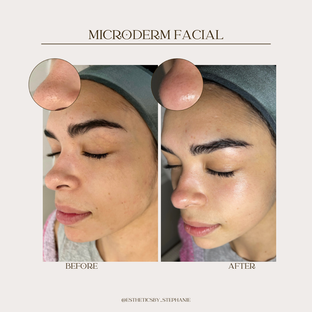 Microdermabrasion Add On