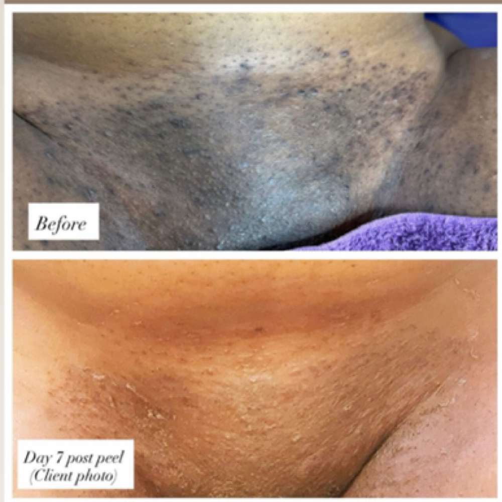 Intimate Bleaching at La.sensationalwaxing in Philadelphia, PA