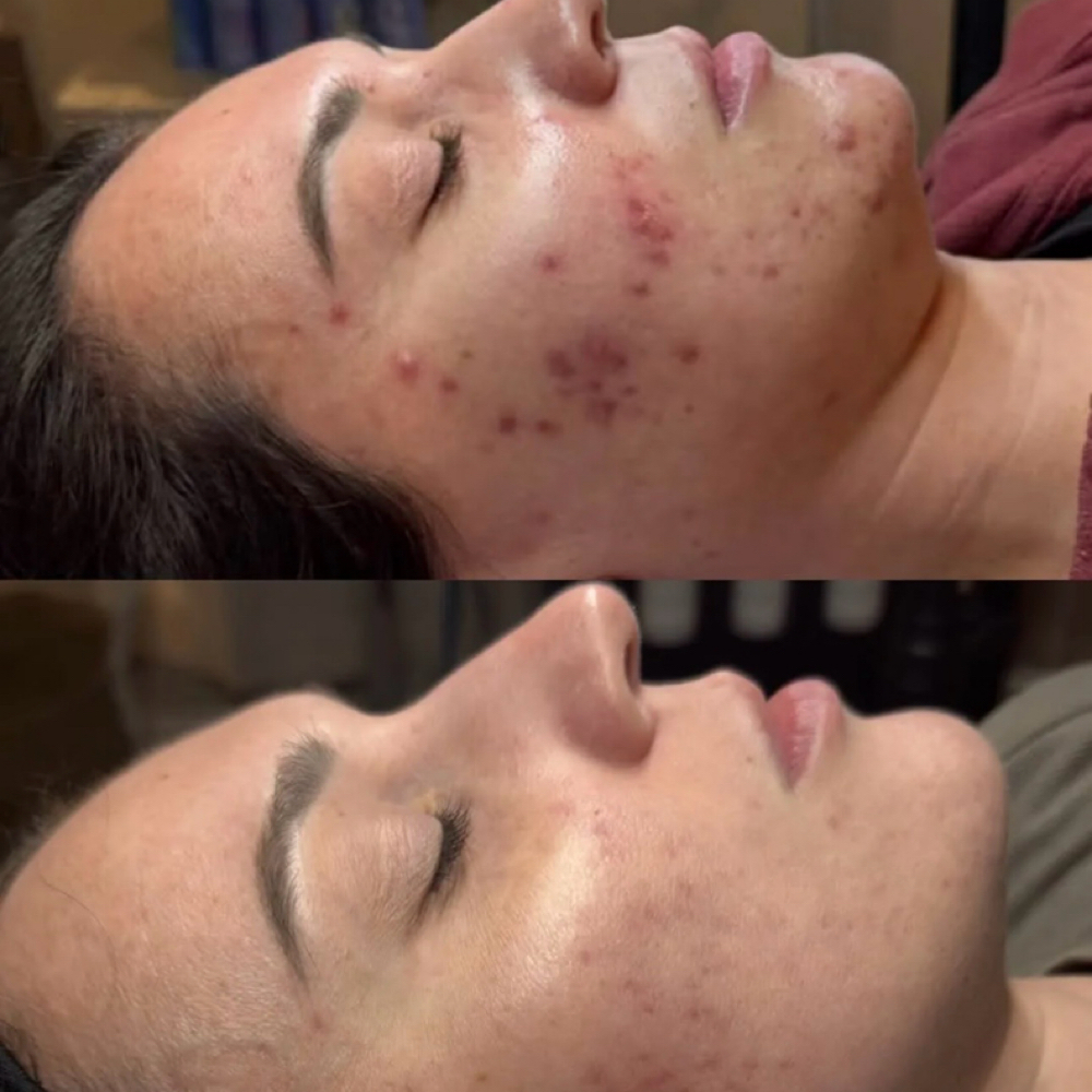 Acne Facial