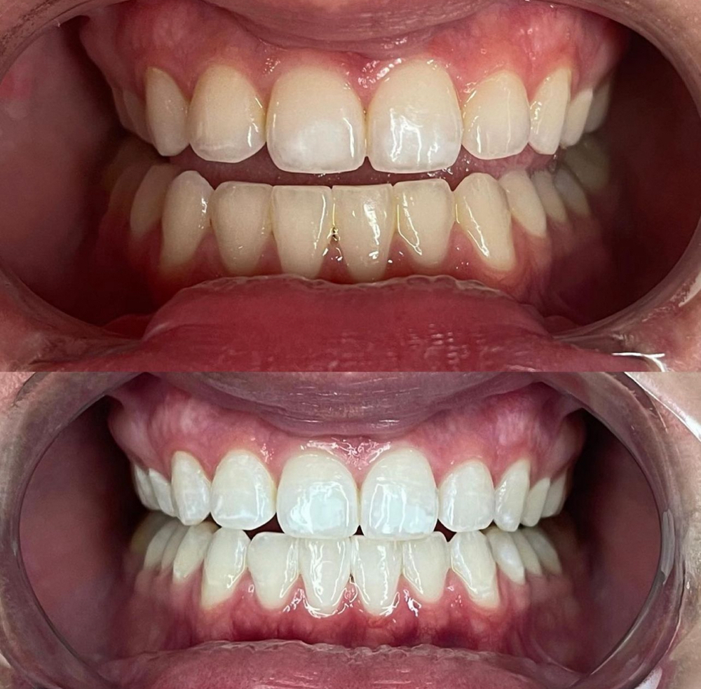 60 Minute Teethwhitening Session