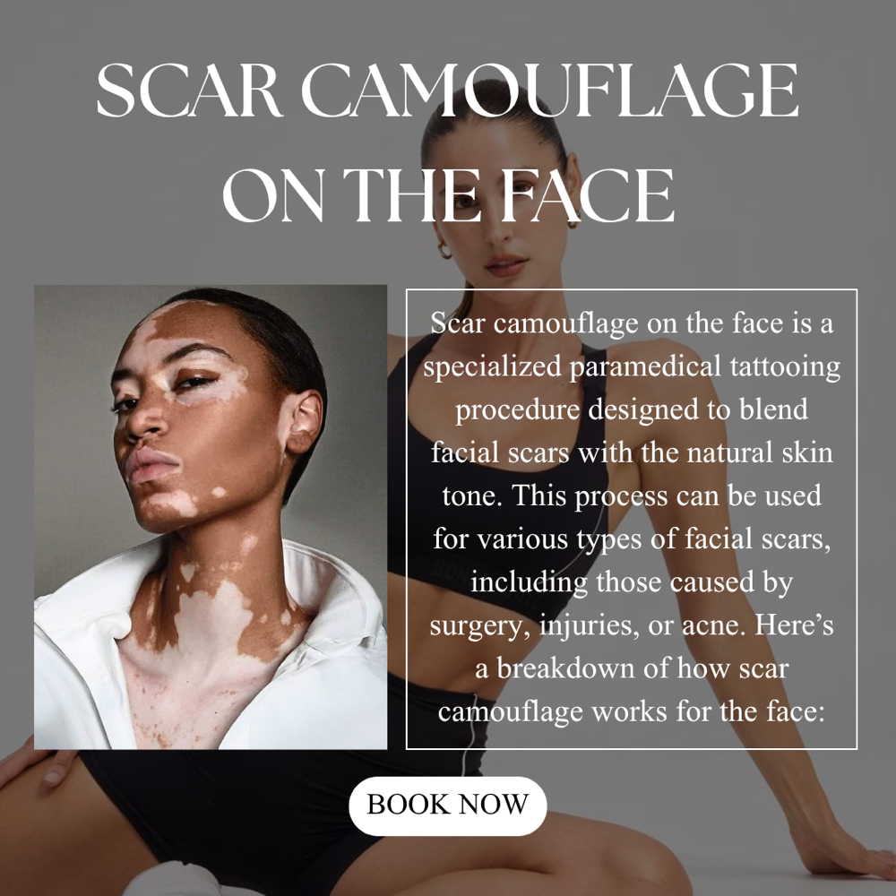 Vitiligo Camouflage