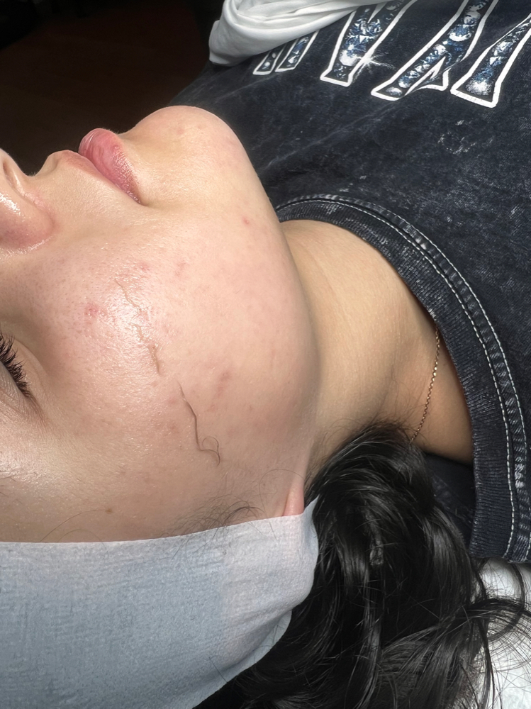 Dermaplane