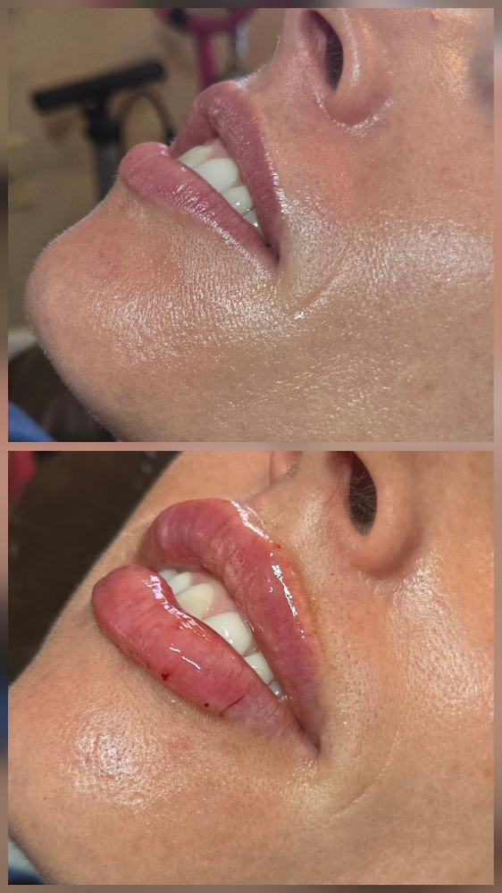 Lip filler at Panhandle Aesthetics in Guymon, OK