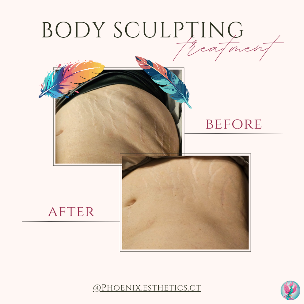Fat/Cellulite Reduction Treatment