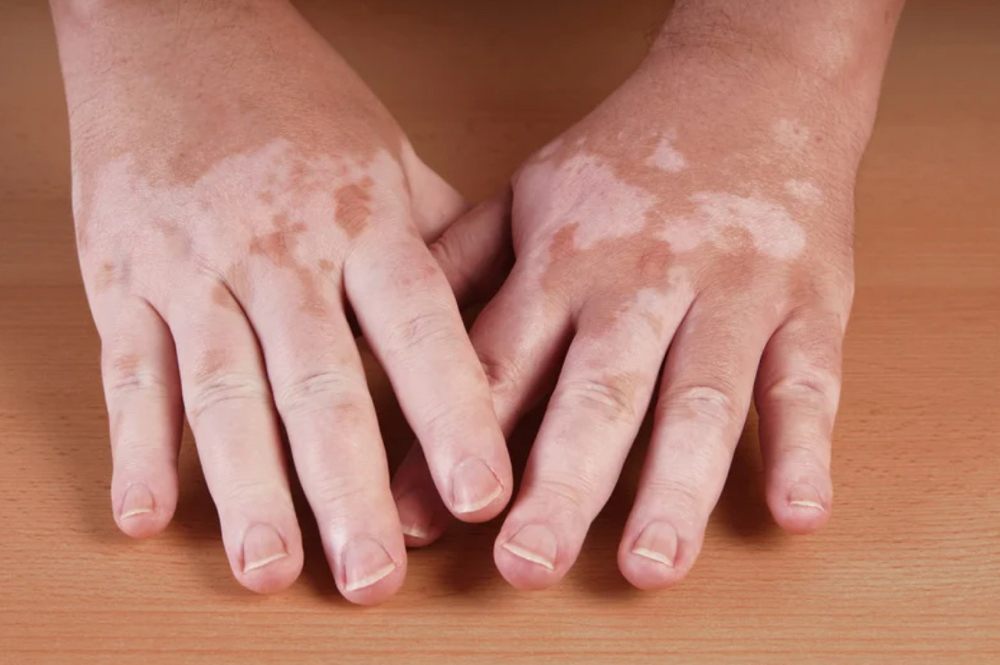 Vitiligo Restoration