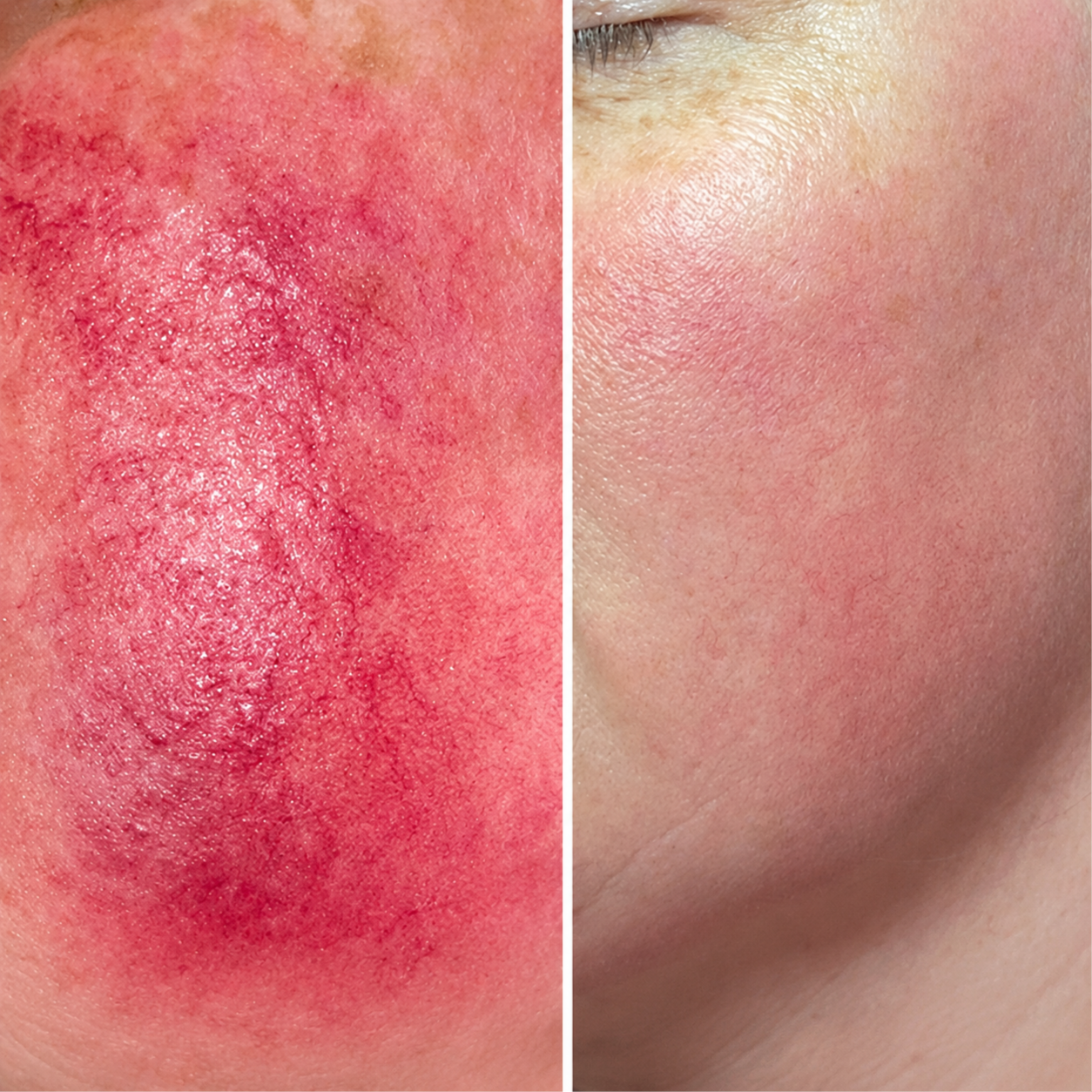 Calming Rosacea Relief at Sculpting Beauty by Pam LLC in Atascocita, TX