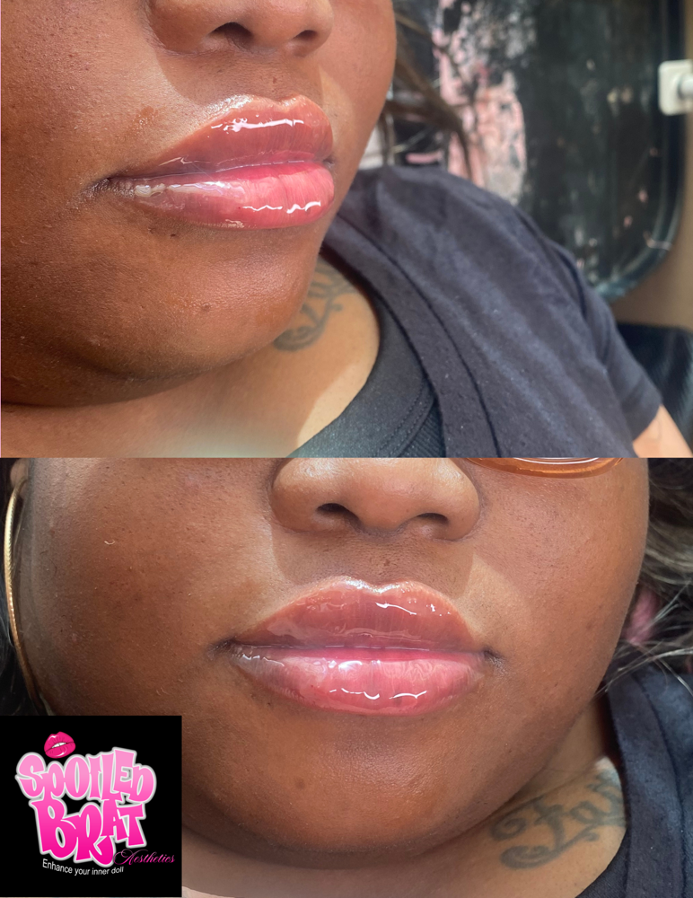 1ML NEEDLESS LIP FILLER