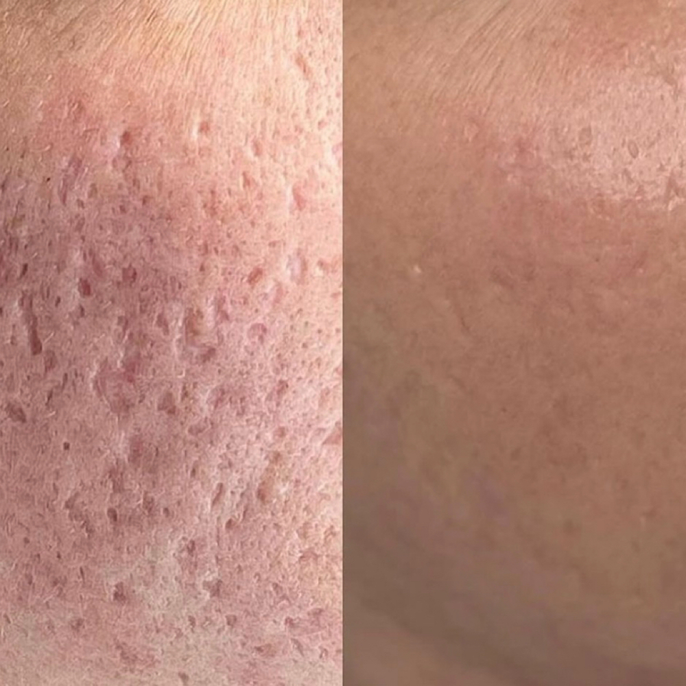 MICRONEEDLING with GROWTH FACTORS at OH  BEAUTY  BAR in Bellingham, WA