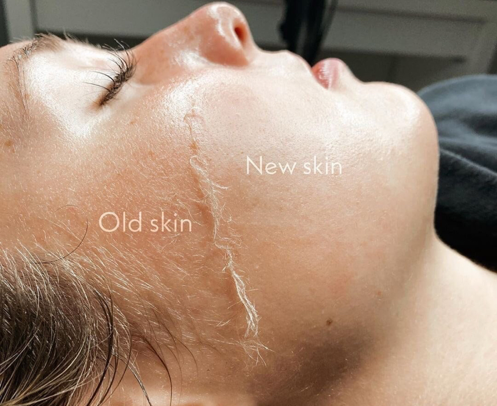 The Derma Facial