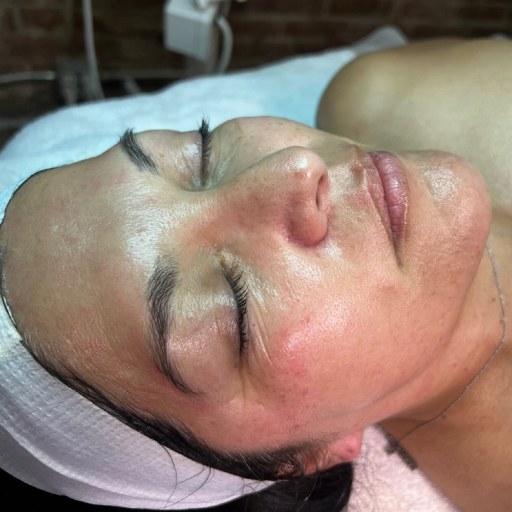 6 Month Dermapalne Package at The Este Lounge in Hanford, CA