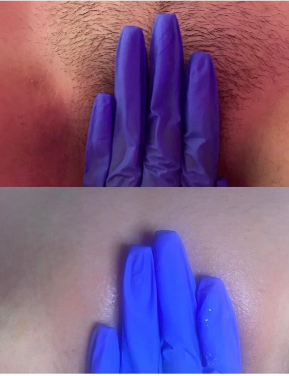 Brazilian Wax