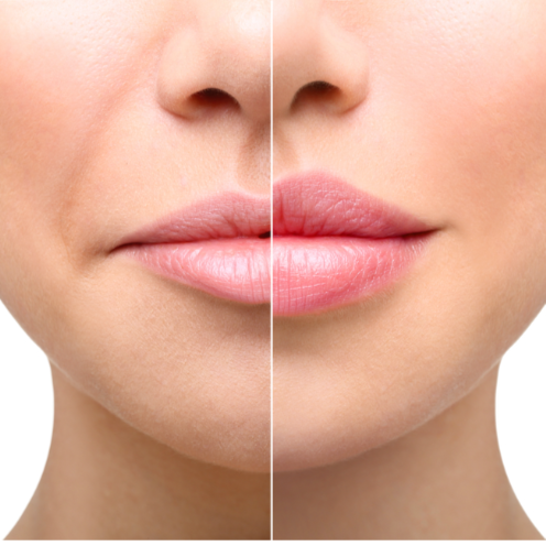 HA dermal filler consultation at Chelsea Injects in Kingwood, TX