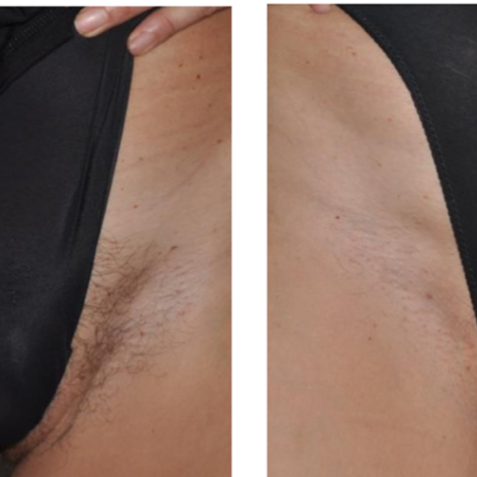 Bikini Laser Hair Removal at The Beautee Spot in Phoenix, AZ