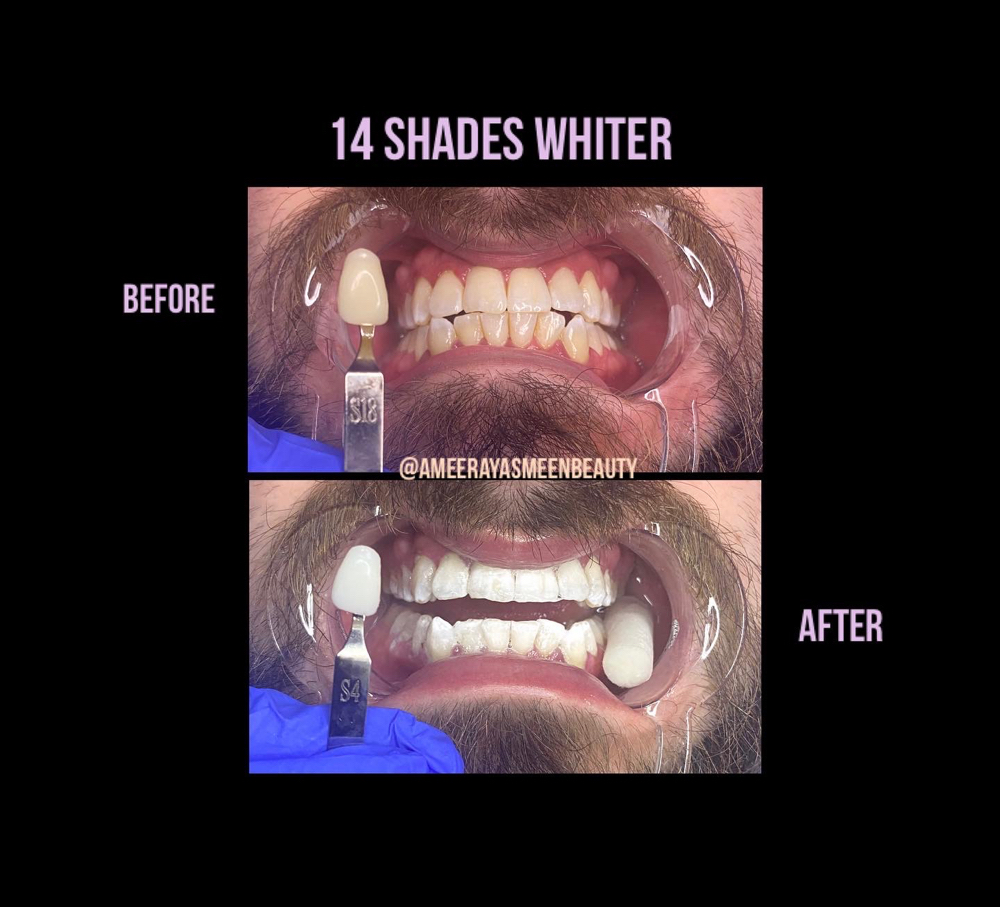 Teeth Whitening - One Session