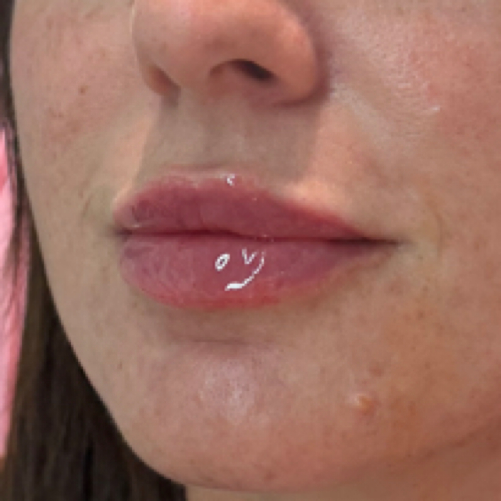 Full Syringe Versa Lips at Alt Boutique & Aesthetics | Nurse Injector in Hereford, TX