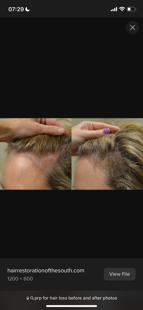 Hair Restoration  (PRF)