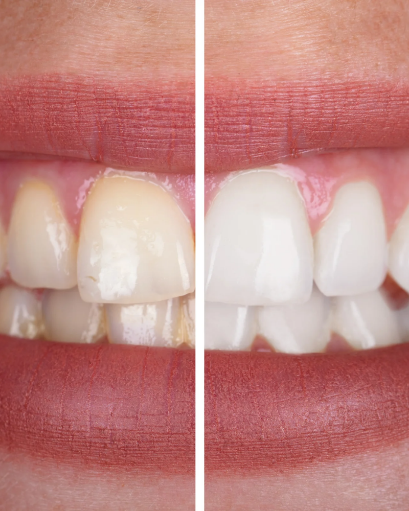 Teeth Whitening Options