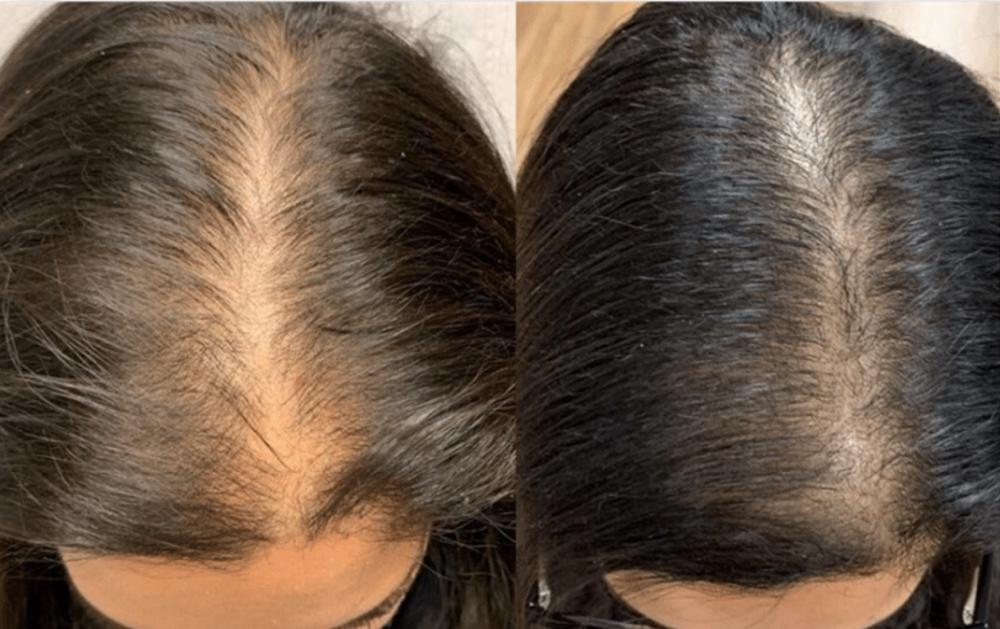 HAIR RESTORATION TREATMENT