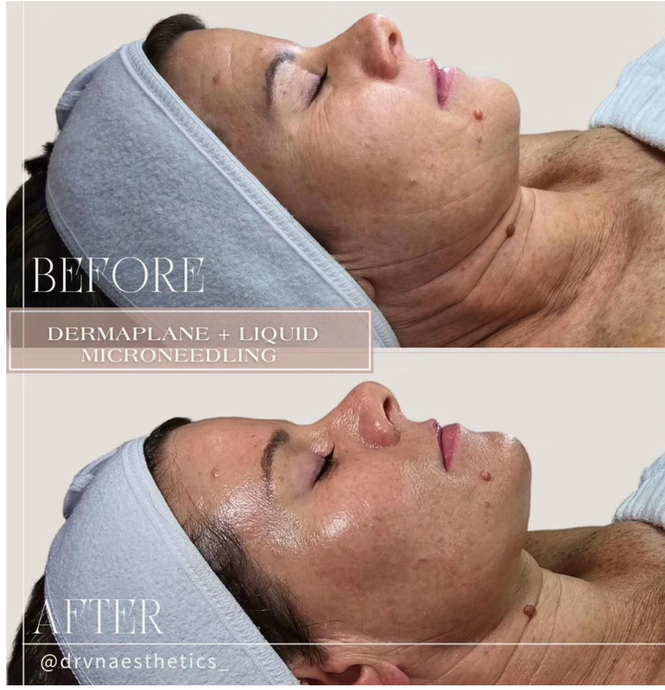 CELLSTORY Liquid Microneedling
