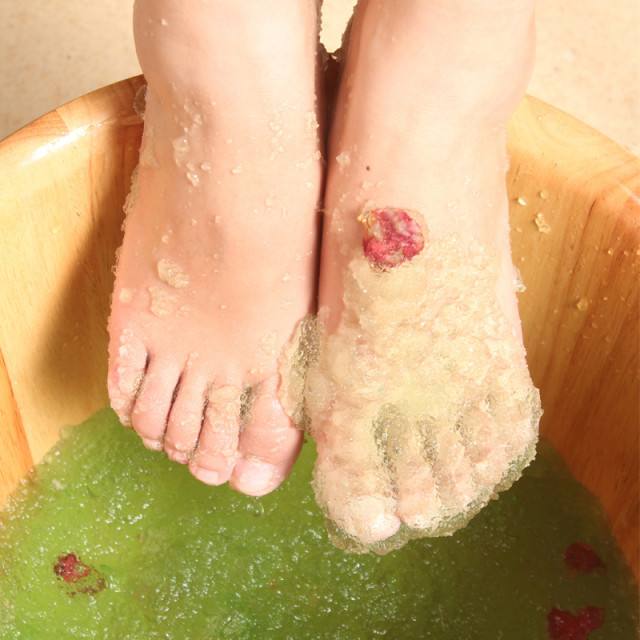 Jelly Treatment