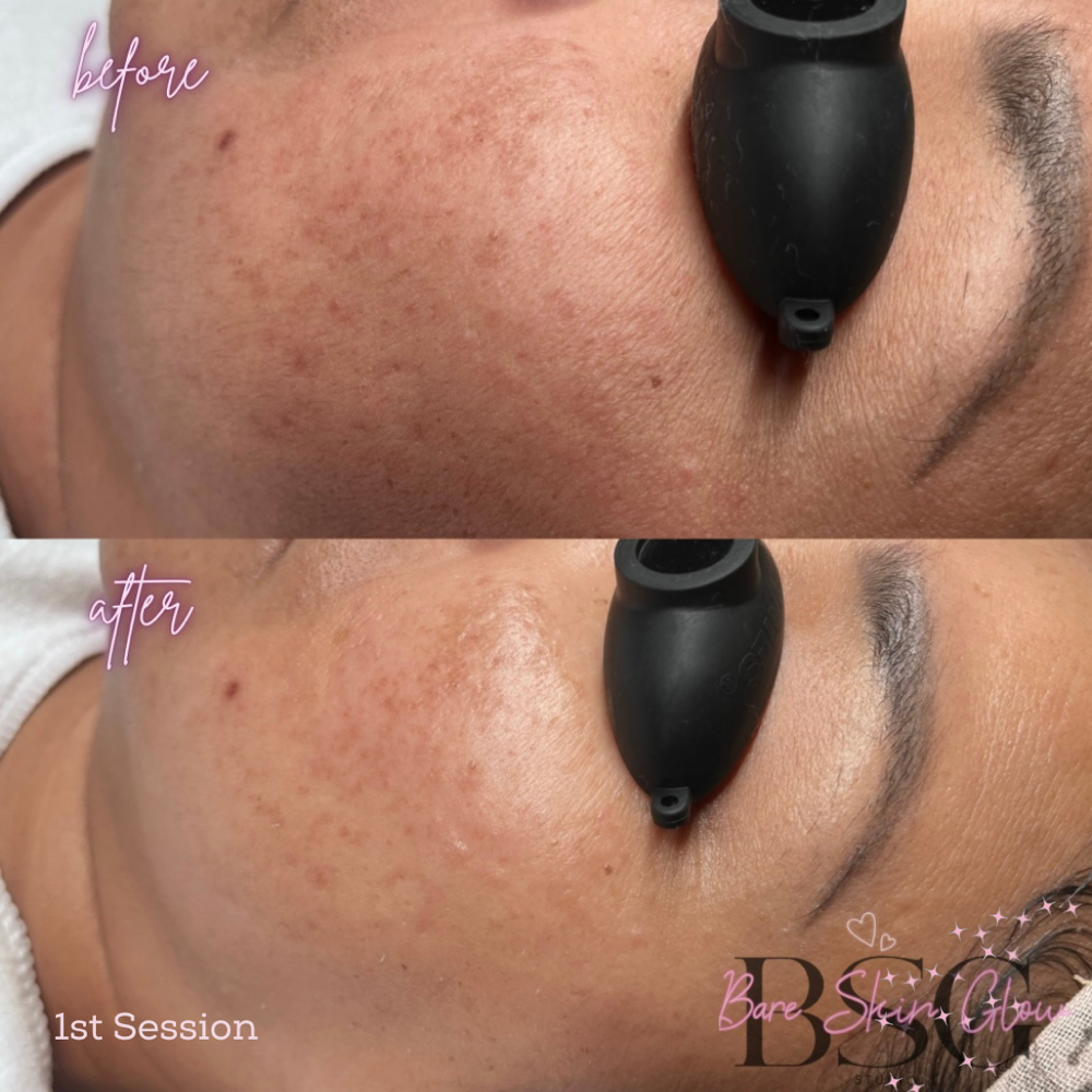Vita Brite Peel Facial
